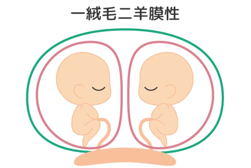 双子の妊娠はいつわかる 双子ママ34人に聞いた妊娠 出産事情 ママびよりウェブ
