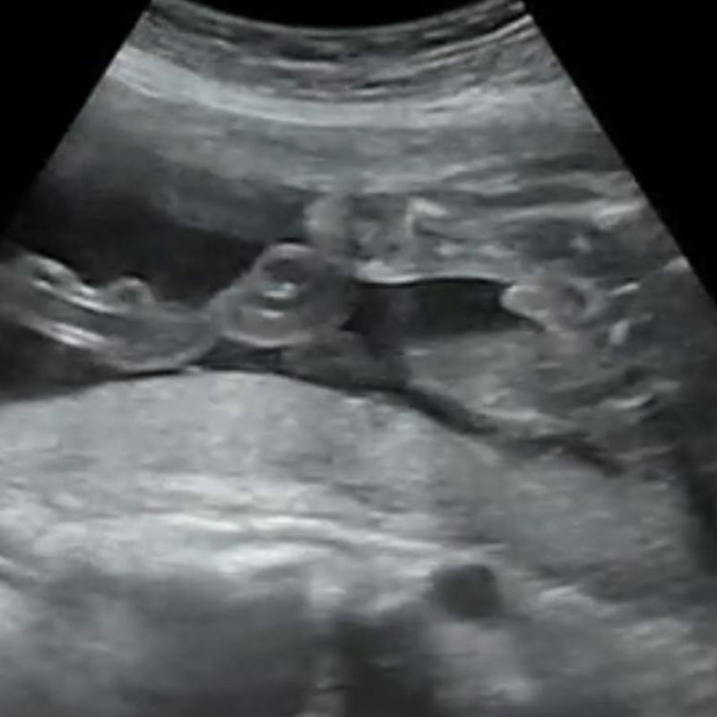 エコー写真 性別の見分け方 妊娠週で男の子女の子エコーまとめました ママびよりウェブ