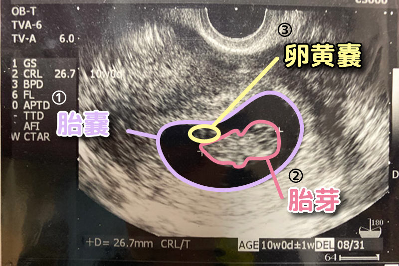 ”妊娠初期のエコー写真。胎嚢・胎芽（胎児）・卵黄嚢が写っている。